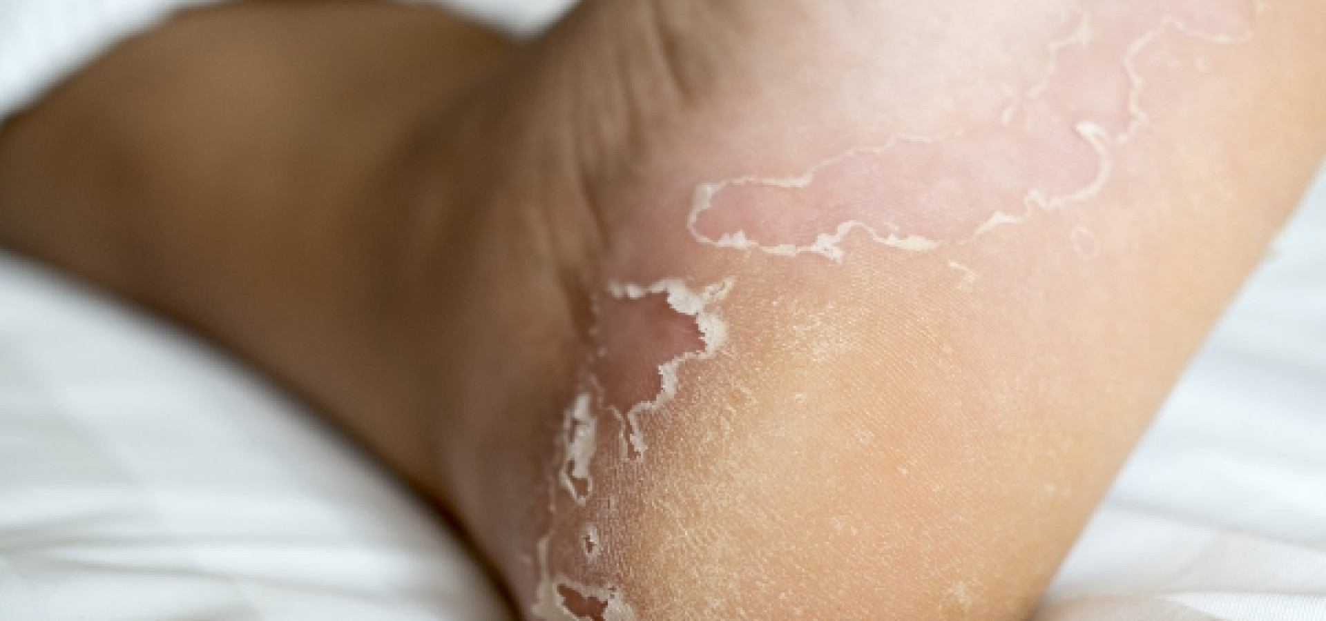 Δέρμα ξεφλούδισμα: Λόγοι για τους οποίους τα πόδια μας μπορεί να ξεφλουδίζουν